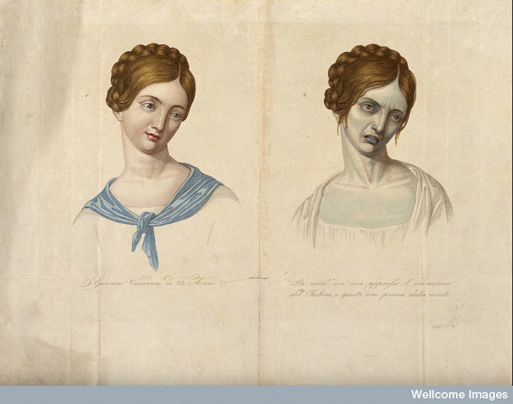 V0010485 A young Venetian woman, aged 23, depicted before and after